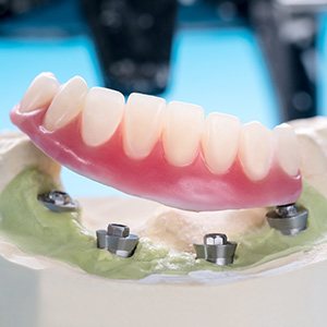 All-on-4 dentures in Homer Glen