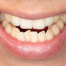 A closeup of a mouth with crowded teeth