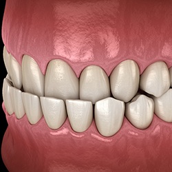 A 3D illustration of an underbite