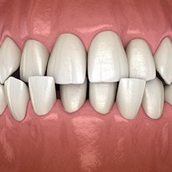 A 3D illustration of a mouth with a crossbite