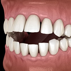 A 3D illustration of a mouth with an open bite