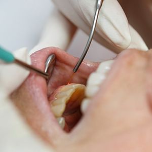 Laser dentistry being used