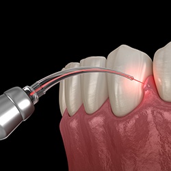 Digital illustration of laser dentistry