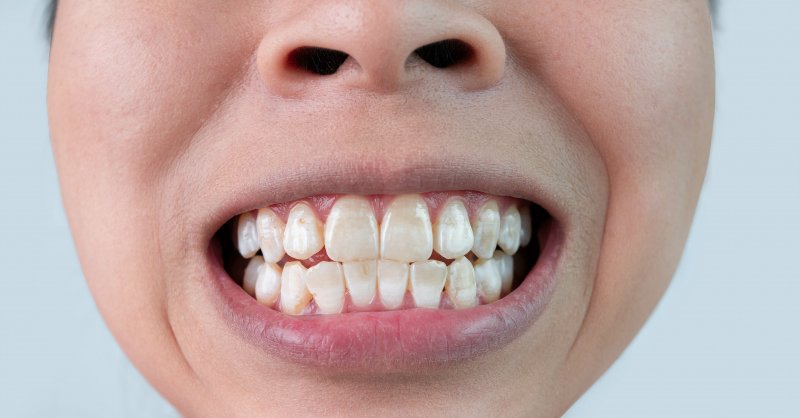 A closeup of a mouth with tooth stains