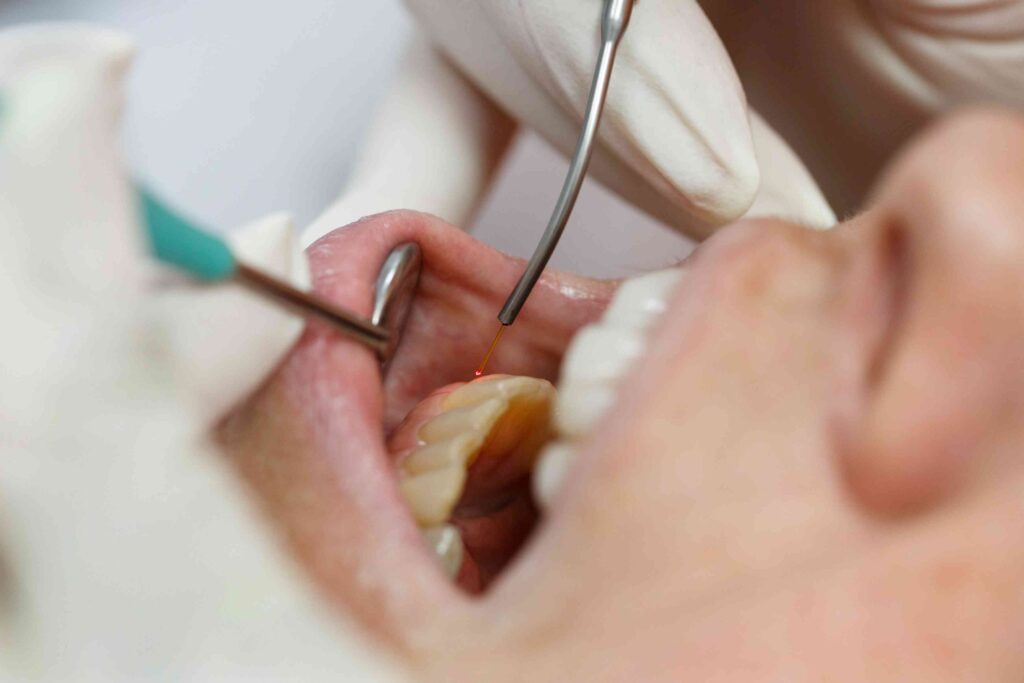 Laser dentistry treatment